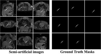 Automatic image-based tracking of gadolinium-filled balloon wedge catheters for MRI-guided cardiac catheterization using deep learning